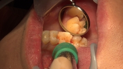 素人Megumi（25）的牙科治疗视频（第一次：口腔特写）*这是同名作品，仅包含口腔内部特写！
