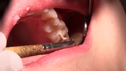 御坂美琴（21）的真实牙科治疗视频（第二次：口腔特写）*这是同名作品，仅包含口腔内部特写！