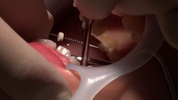業餘Makoto的真實牙科治療影片（第五：口腔內部特寫影片）*這是同名作品，僅包含口腔內部的特寫鏡頭！